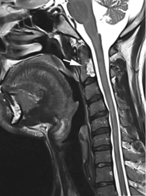 Lateral x-ray demonstrates presence of chordoma at C1-C2 cervical spine.